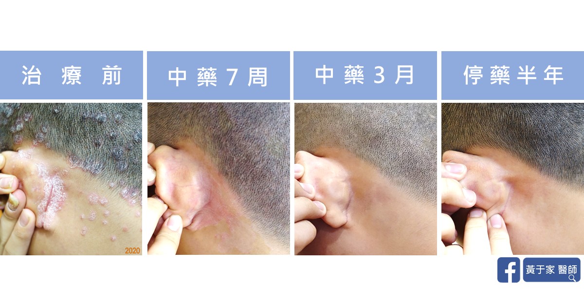 乾癬患者治療前後皮膚外觀比對（4）