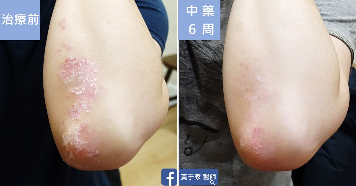乾癬患者治療前後皮膚外觀比對（1）