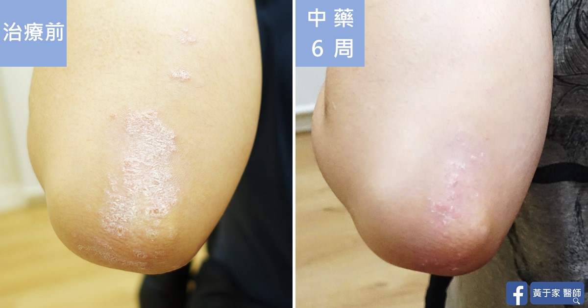 乾癬患者治療前後皮膚外觀比對（2）