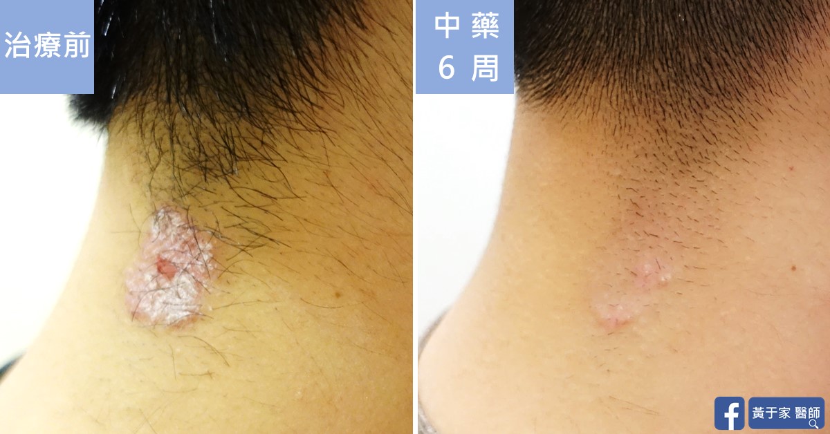 乾癬患者治療前後皮膚外觀比對（3）