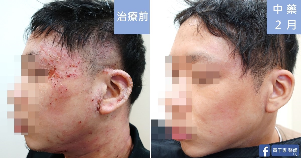 類固醇戒斷患者治療前後皮膚外觀比對（1）