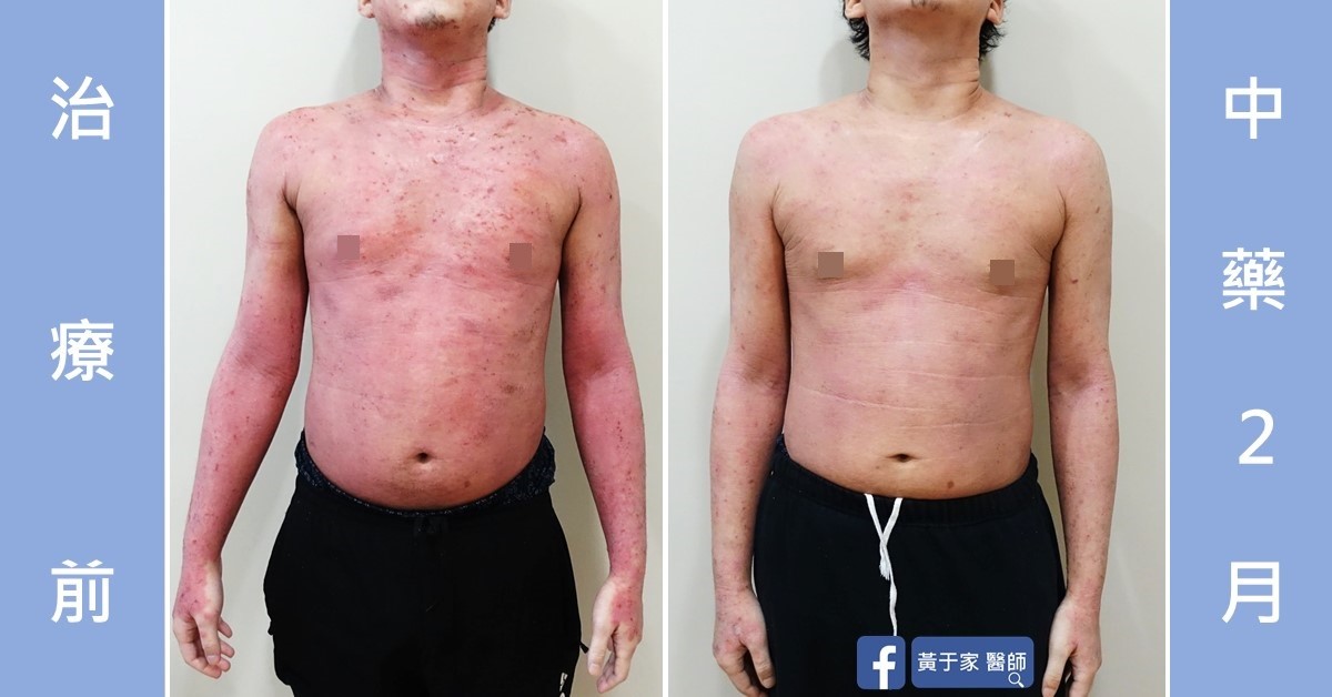 類固醇戒斷患者治療前後皮膚外觀比對（3）