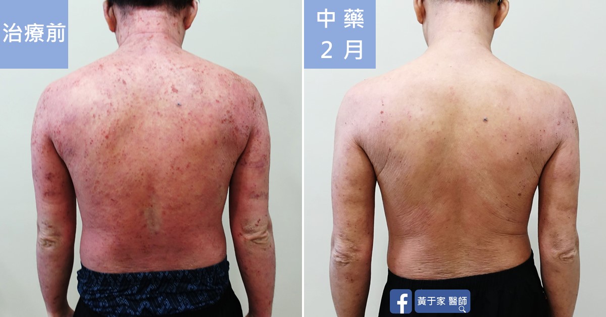 類固醇戒斷患者治療前後皮膚外觀比對（4）