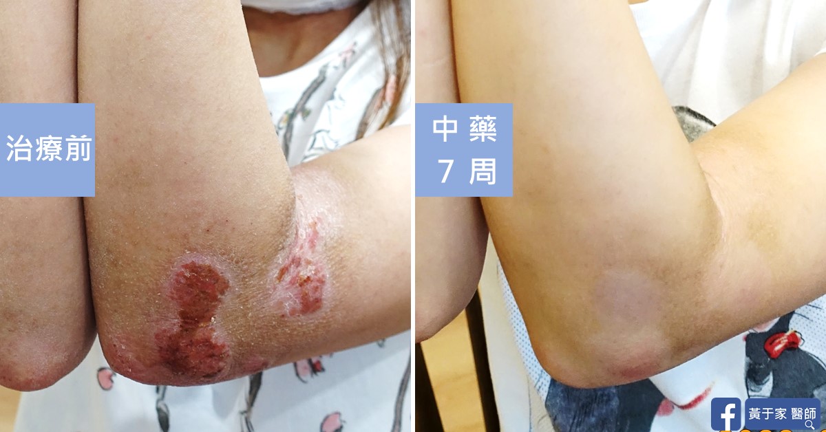 類固醇戒斷患者治療前後皮膚外觀比對（1）