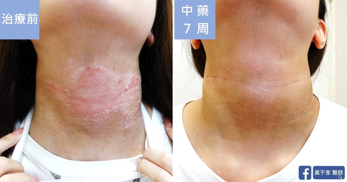 類固醇戒斷患者治療前後皮膚外觀比對（2）