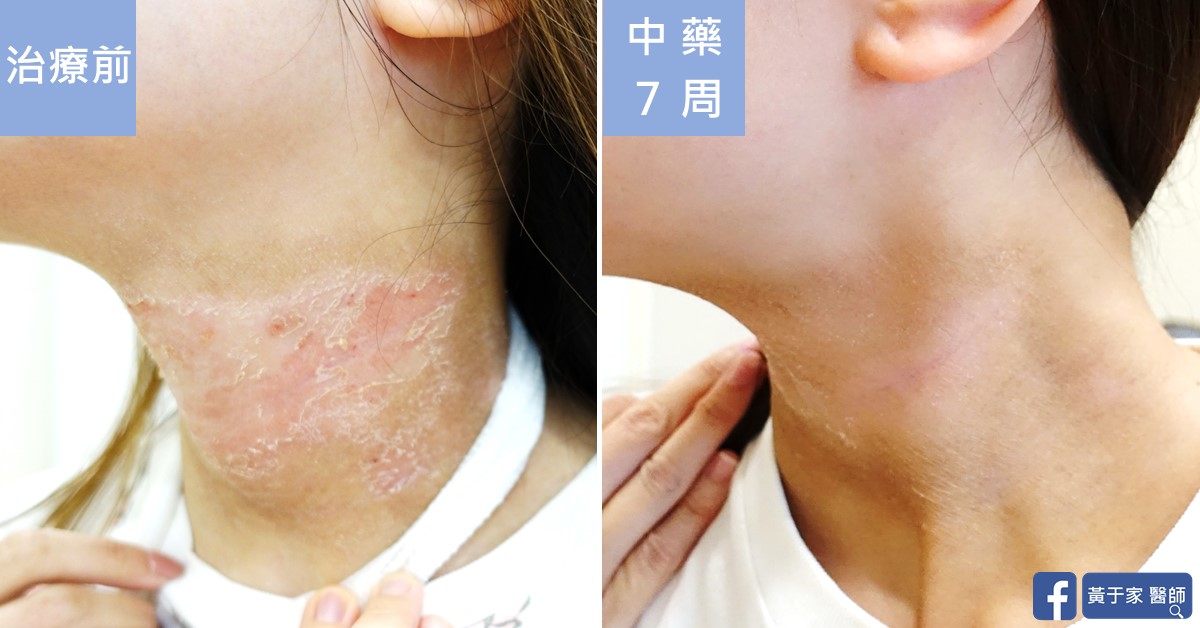 類固醇戒斷患者治療前後皮膚外觀比對（3）