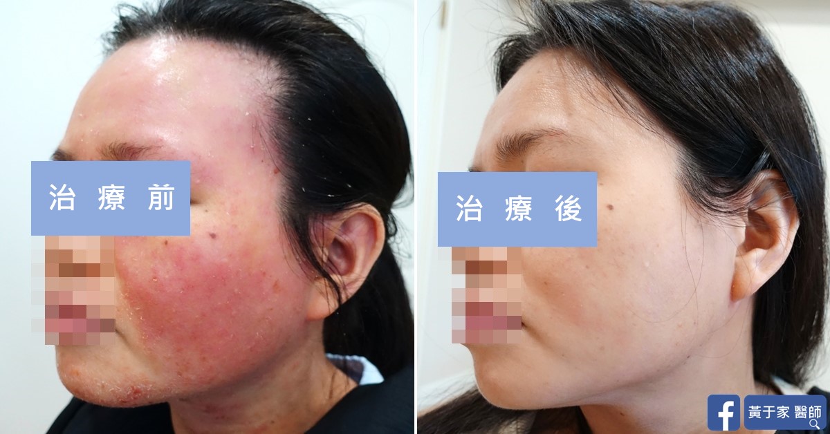 同一位患者左側臉的比對,左標示「治療前」,臉頰泛紅脫屑;右標示「治療後」