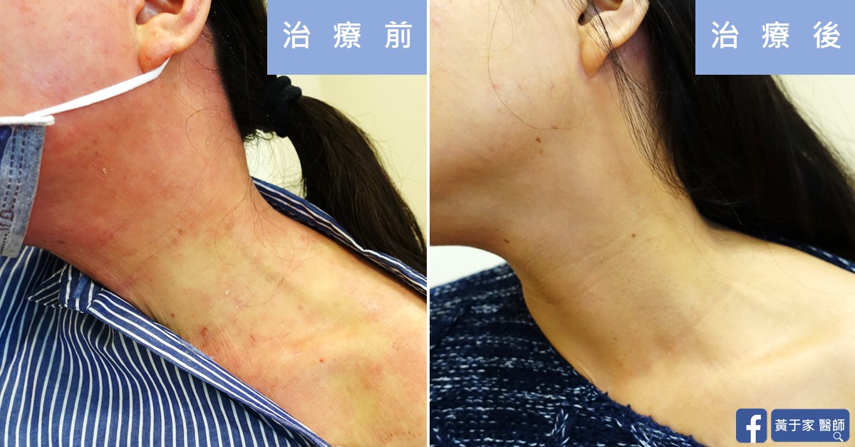 同一位患者右側頸部的比對,左標示「治療前」,泛紅粗糙;右標示「治療後」