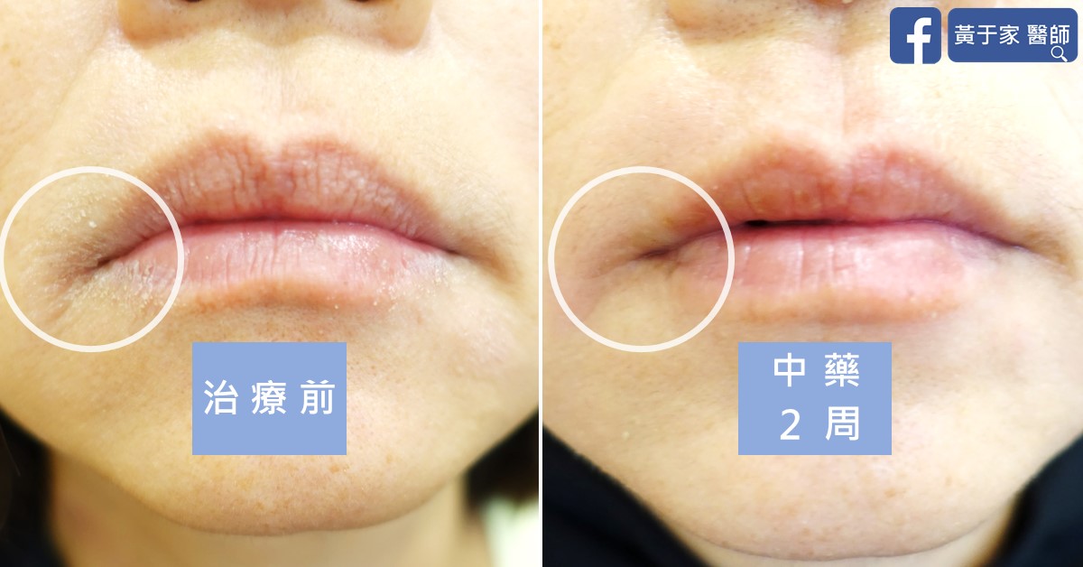 同一位患者嘴唇的比對，圈出嘴角處；左標示「治療前」，嘴角與唇面脫屑；右標示「中藥 2 周」