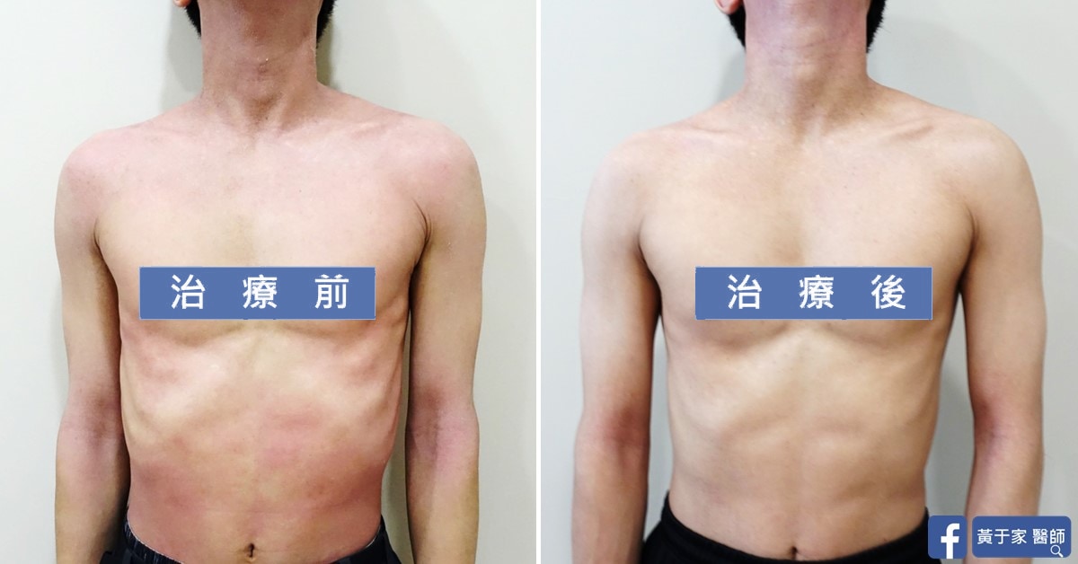 異位性皮膚炎