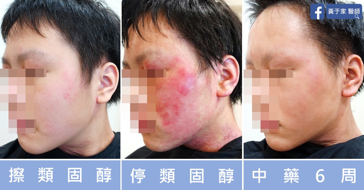 類固醇戒斷患者治療前後皮膚外觀比對
