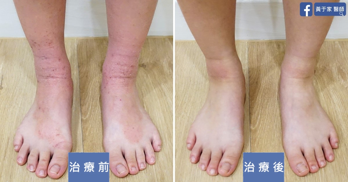 小兒異位性皮膚炎
