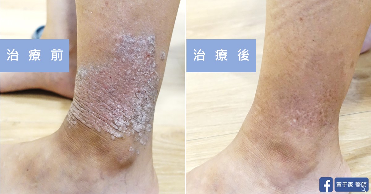 乾癬患者治療前後皮膚外觀比對