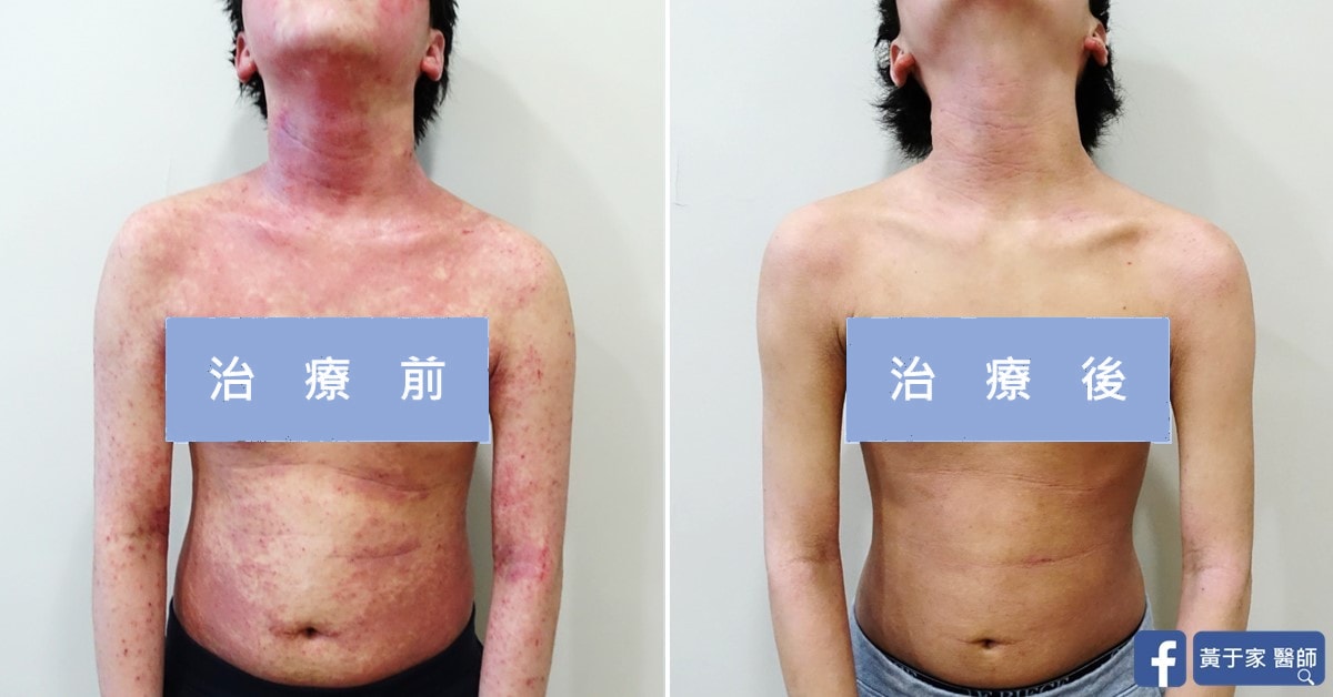 同一位小兒異位性皮膚炎患者胸腹與雙臂的比對，左標示「治療前」整片泛紅並布滿紅點，右標示「治療後」