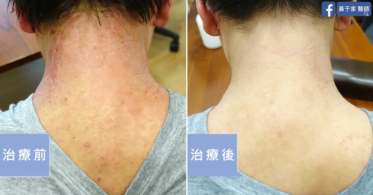 同一位患者後頸的比對，左標示「治療前」泛紅脫屑，右標示「治療後」