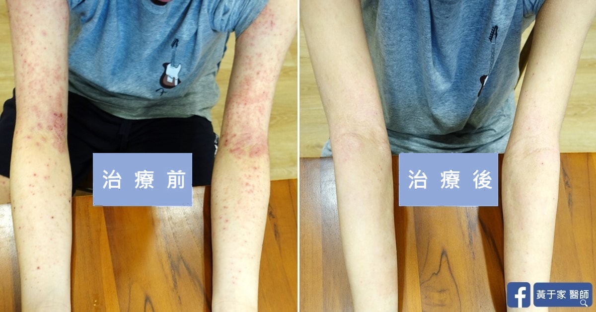 同一位患者雙前臂的比對，左標示「治療前」布滿紅色丘疹，右標示「治療後」明顯減少