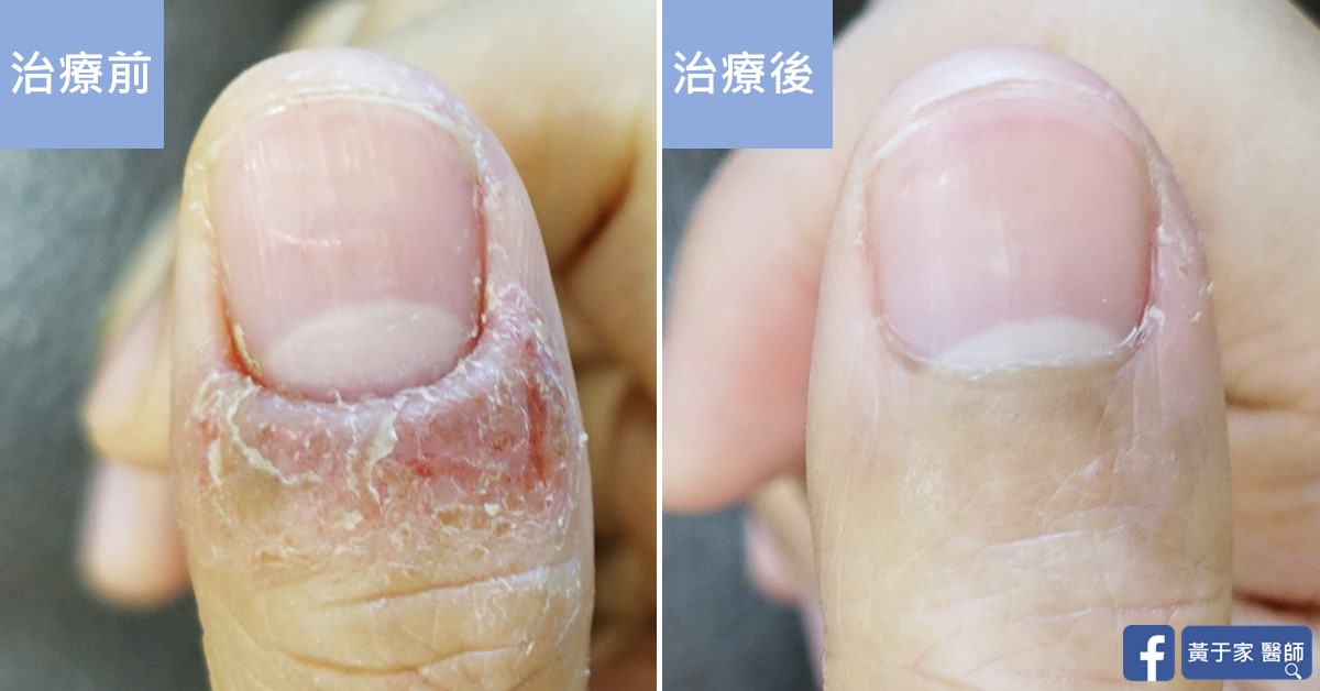手部濕疹患者治療前後皮膚外觀比對