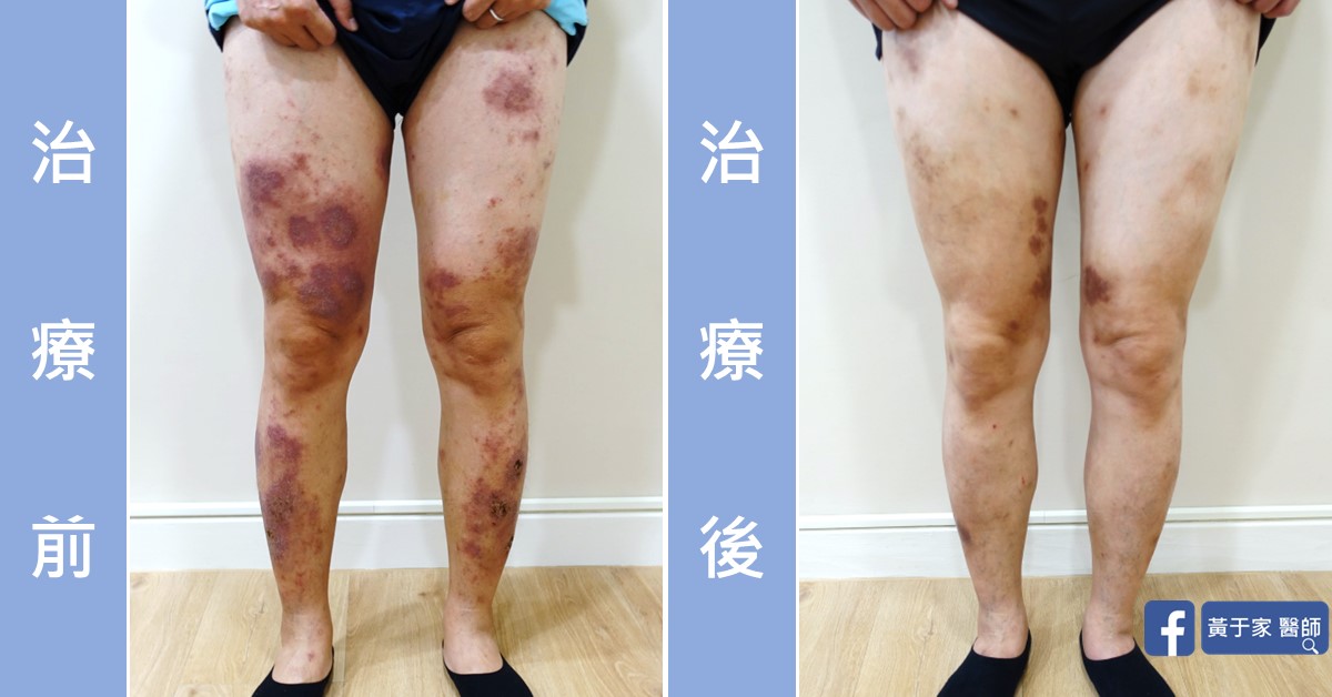 結節性癢疹患者治療前後皮膚外觀比對