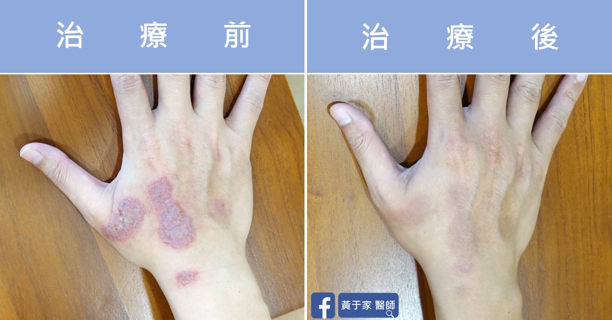 手部濕疹患者治療前後皮膚外觀比對