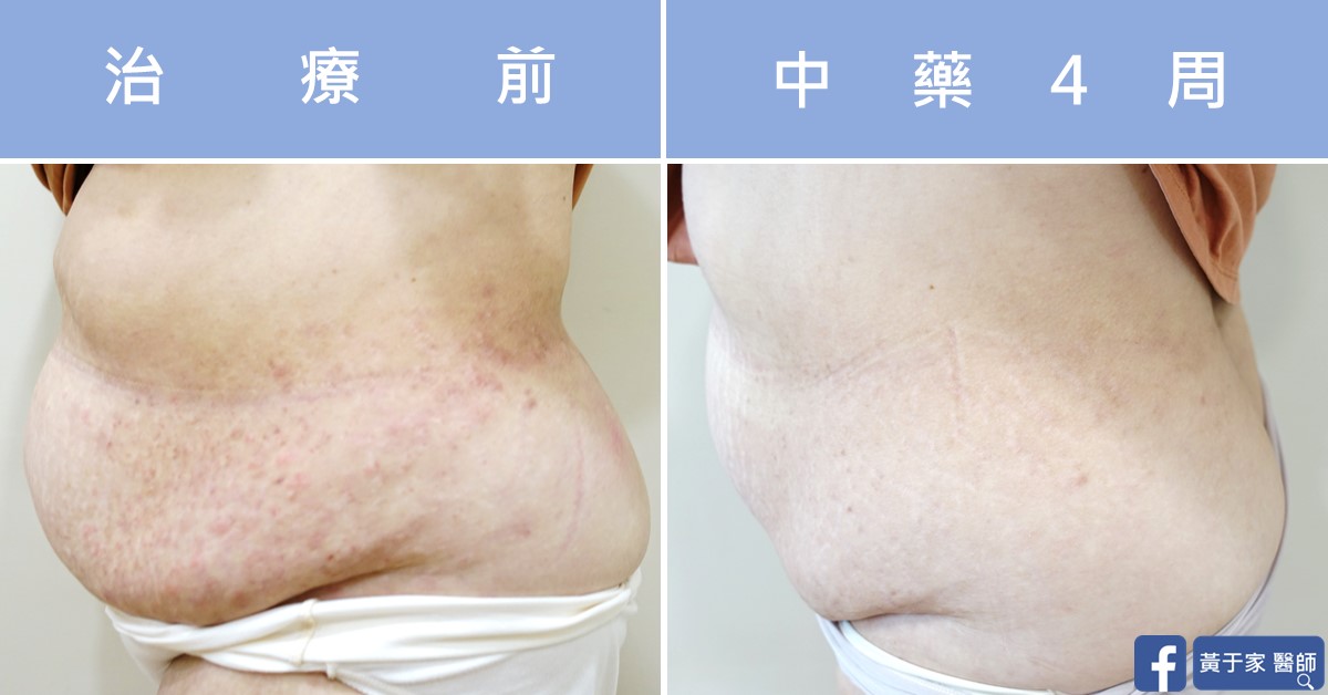 慢性蕁麻疹患者治療前後皮膚外觀比對