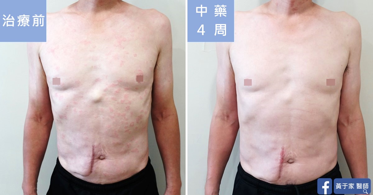 慢性蕁麻疹患者治療前後皮膚外觀比對