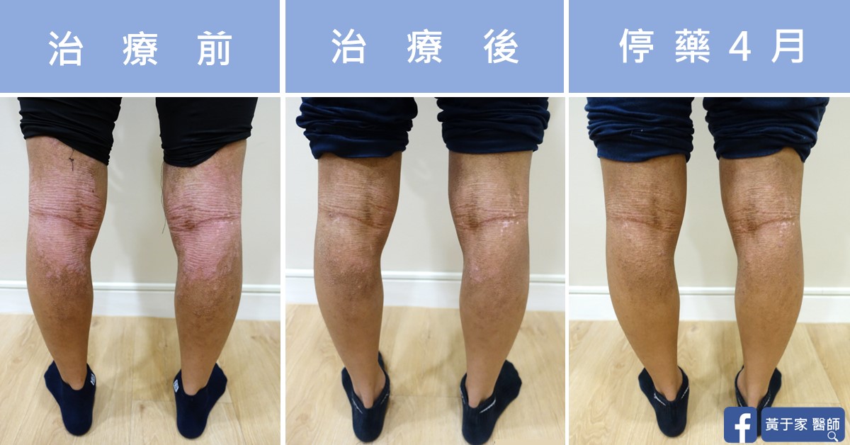 同一位患者雙膝後側的三張比對,依序標示「治療前」「治療後」「停藥 4 月」