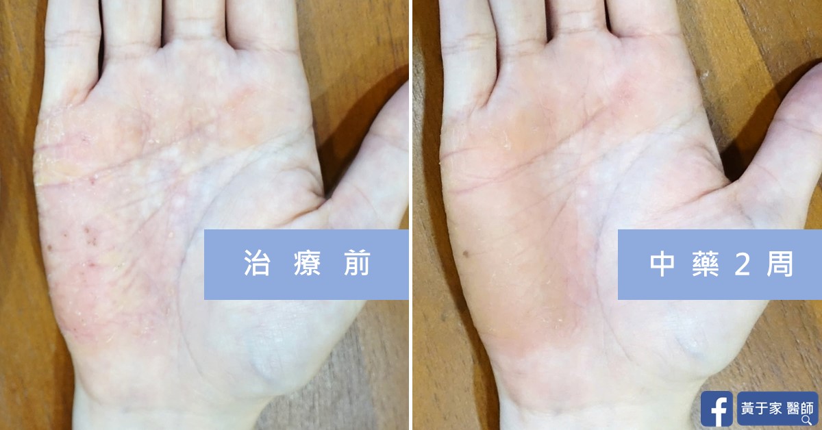 手部濕疹患者治療前後皮膚外觀比對