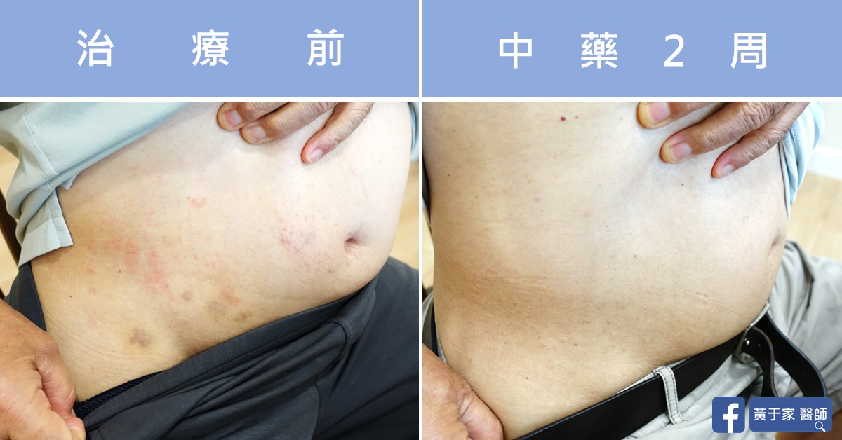 慢性蕁麻疹患者治療前後皮膚外觀比對