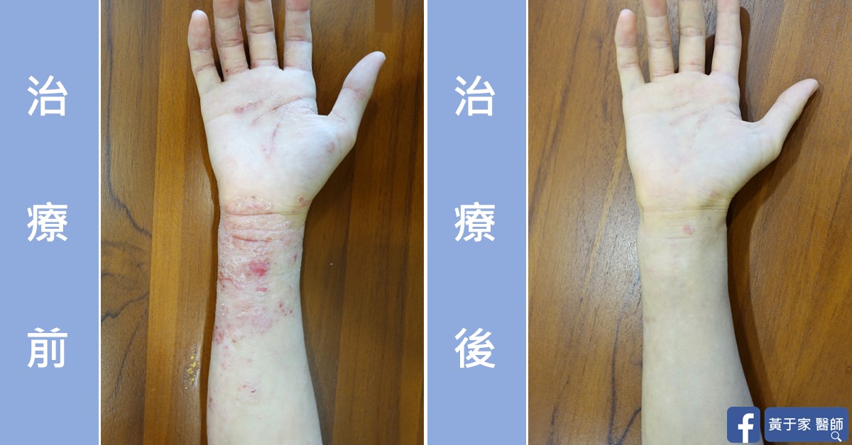 手部濕疹患者治療前後皮膚外觀比對