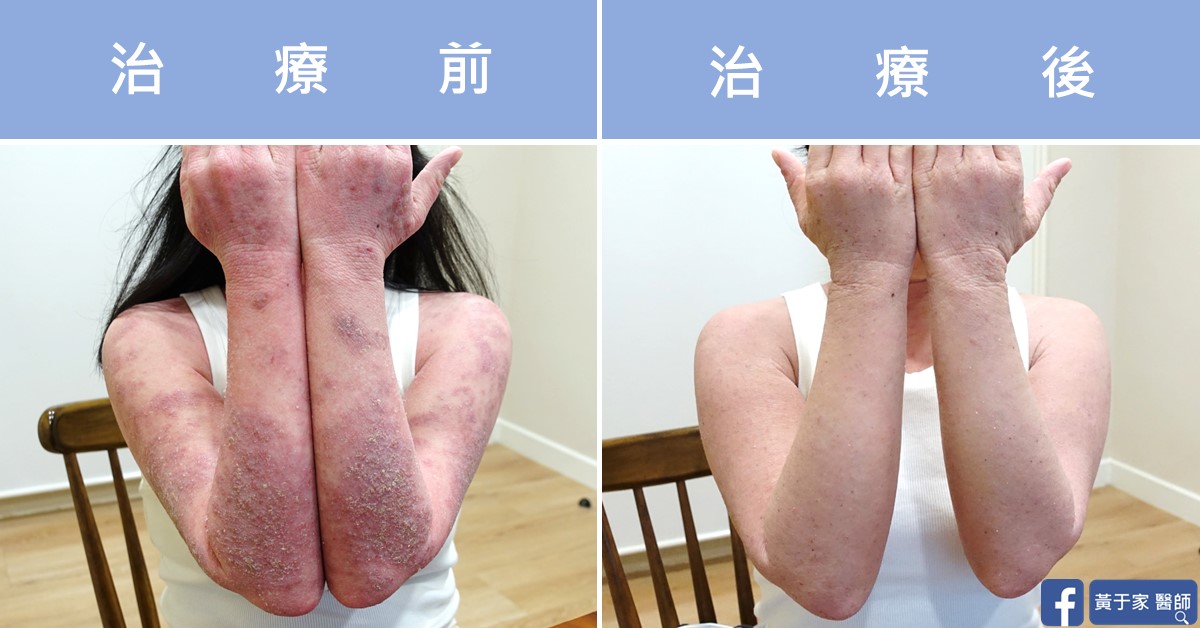 同一位患者雙前臂內側併攏的比對,左標示「治療前」,右標示「治療後」