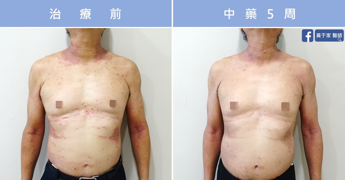 同一位慢性蕁麻疹患者軀幹的兩張並排照片，分別標示「治療前」與「中藥 5 周」