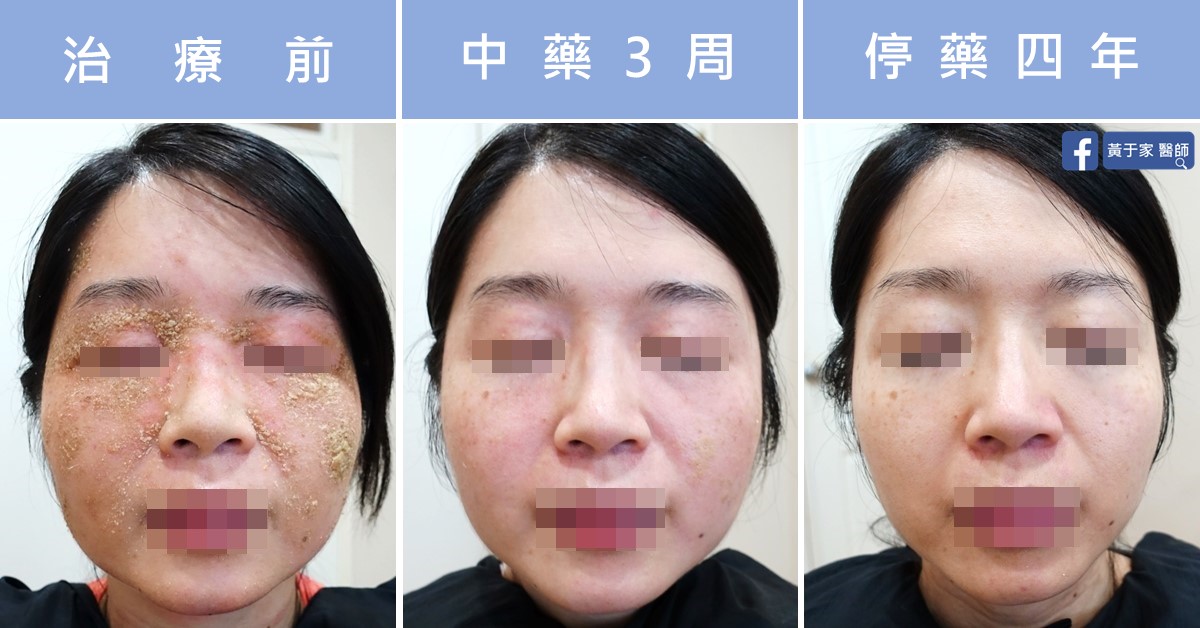 同一位慢性濕疹患者臉部的三張並排照片，依序標示「治療前」「中藥 3 周」「停藥四年」，眼部與唇部已做去識別處理