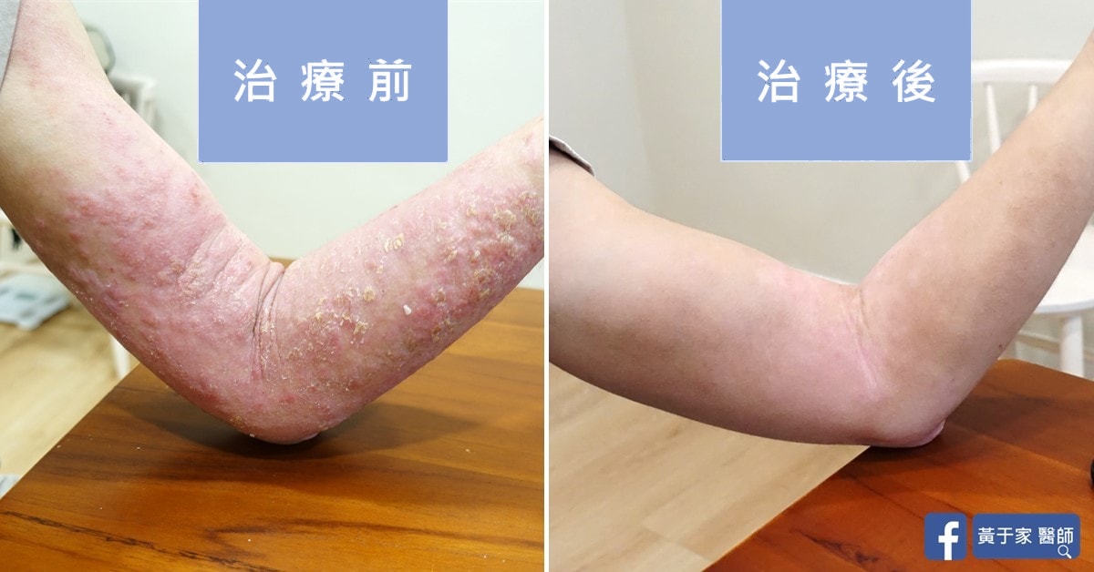 同一位慢性濕疹患者手肘與前臂的比對，左標示「治療前」皮膚增厚泛紅、布滿脫屑，右標示「治療後」