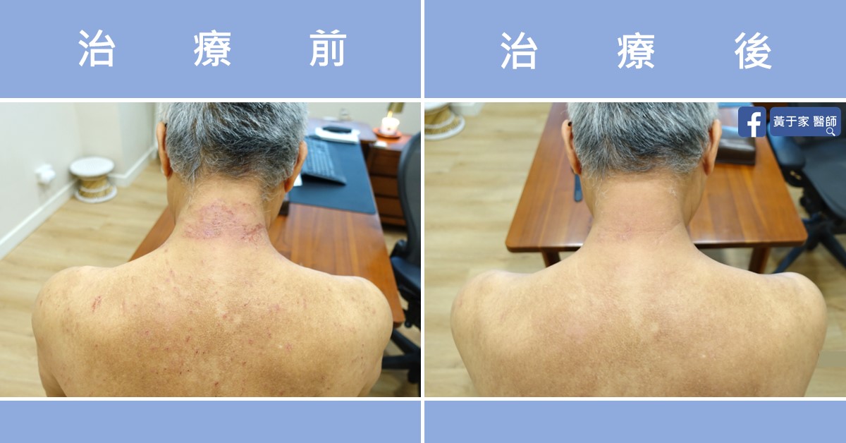慢性蕁麻疹患者治療前後皮膚外觀比對（1）
