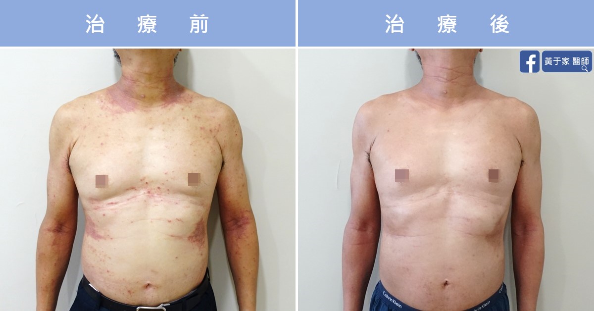 慢性蕁麻疹患者治療前後皮膚外觀比對（2）