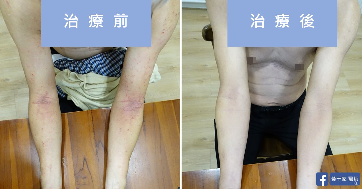 慢性蕁麻疹患者治療前後皮膚外觀比對（3）