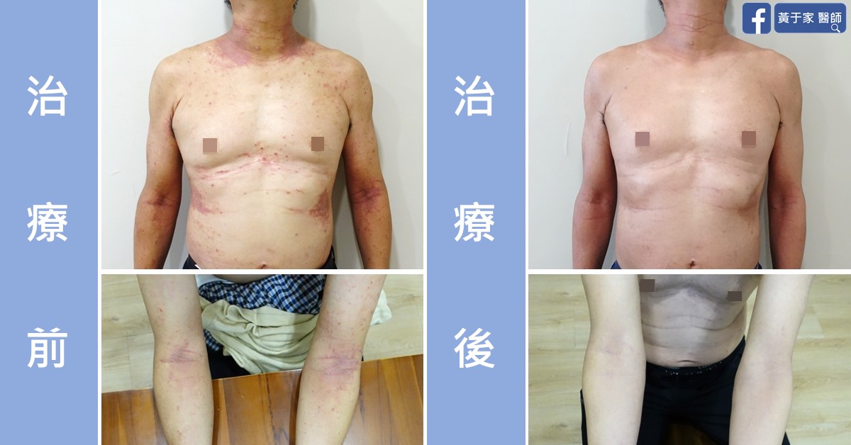 慢性蕁麻疹患者治療前後皮膚外觀比對（4）