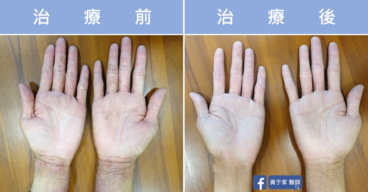 同一位富貴手患者雙手掌的兩張並排照片，分別標示「治療前」與「治療後」