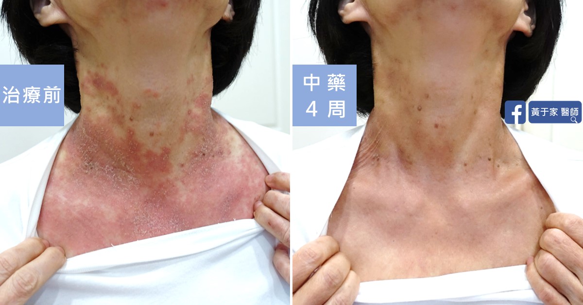 慢性蕁麻疹患者治療前後皮膚外觀比對（1）