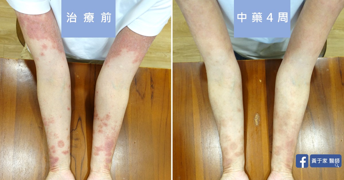 慢性蕁麻疹患者治療前後皮膚外觀比對（2）