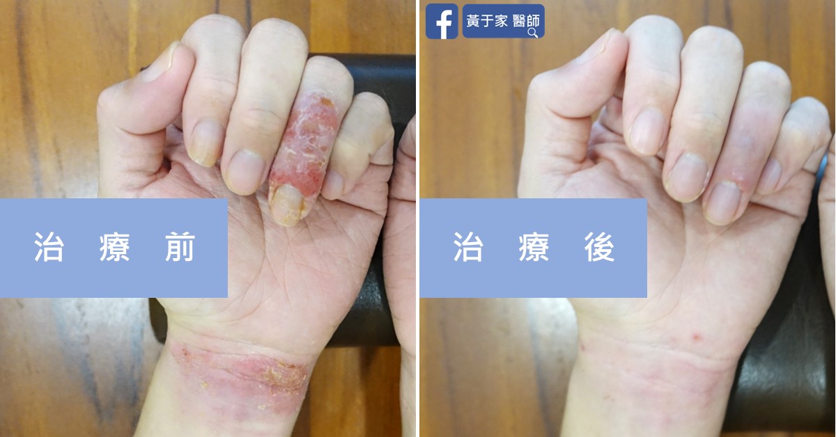 手部濕疹患者治療前後皮膚外觀比對