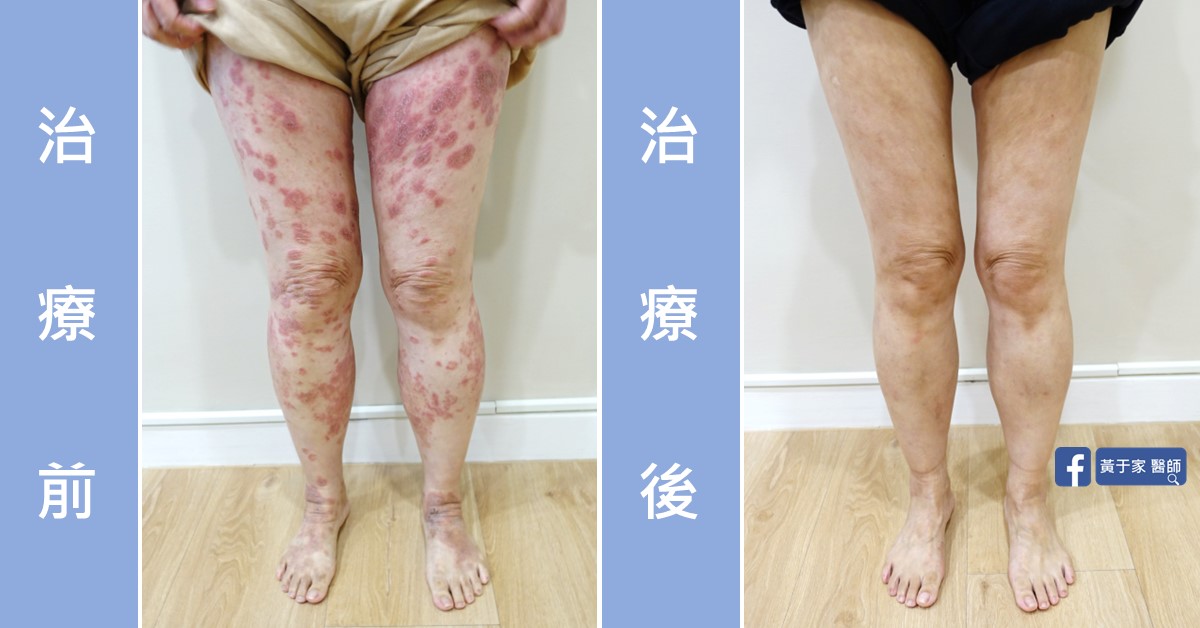 慢性濕疹患者治療前後皮膚外觀比對