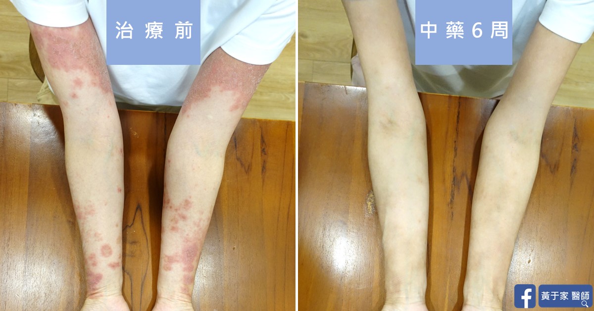 慢性蕁麻疹患者治療前後皮膚外觀比對（1）