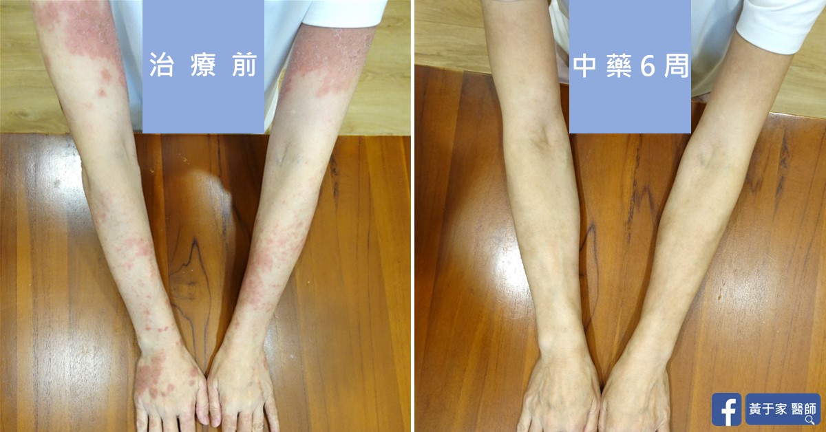 慢性蕁麻疹患者治療前後皮膚外觀比對（2）