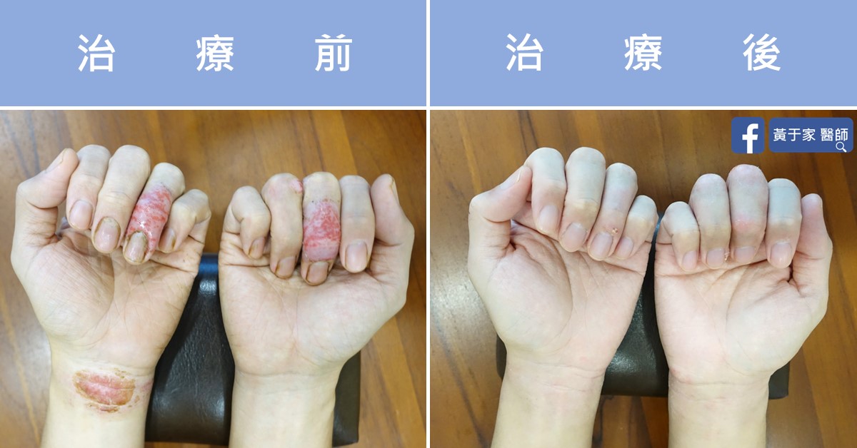 手部濕疹患者治療前後皮膚外觀比對
