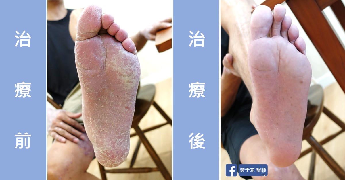 乾癬患者治療前後皮膚外觀比對