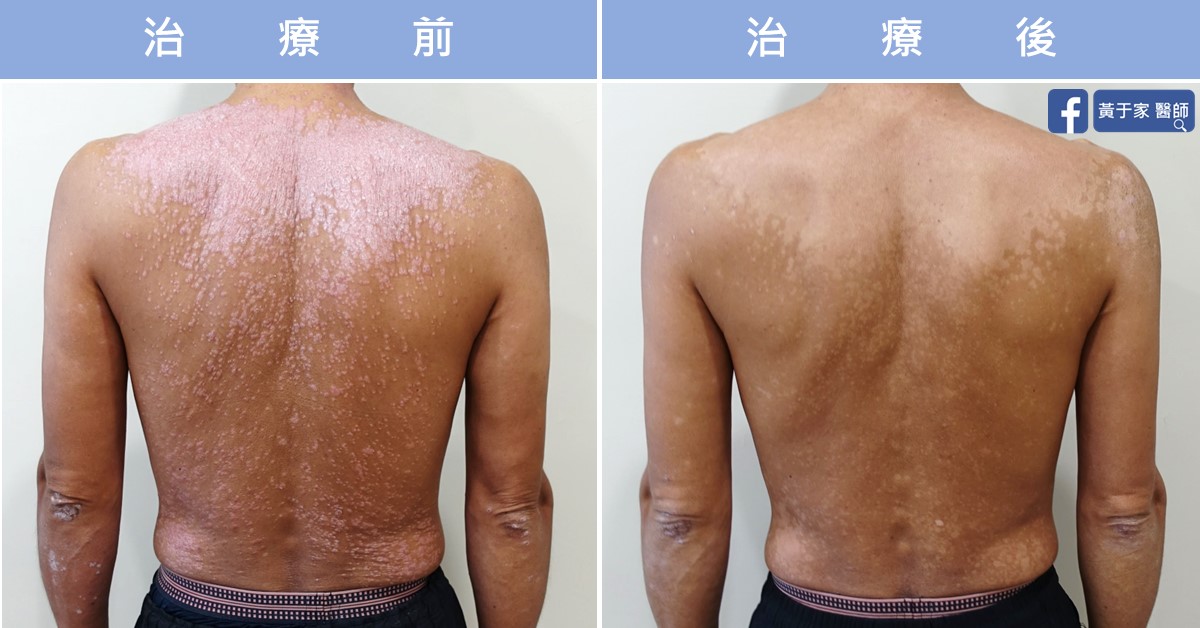 乾癬患者治療前後皮膚外觀比對