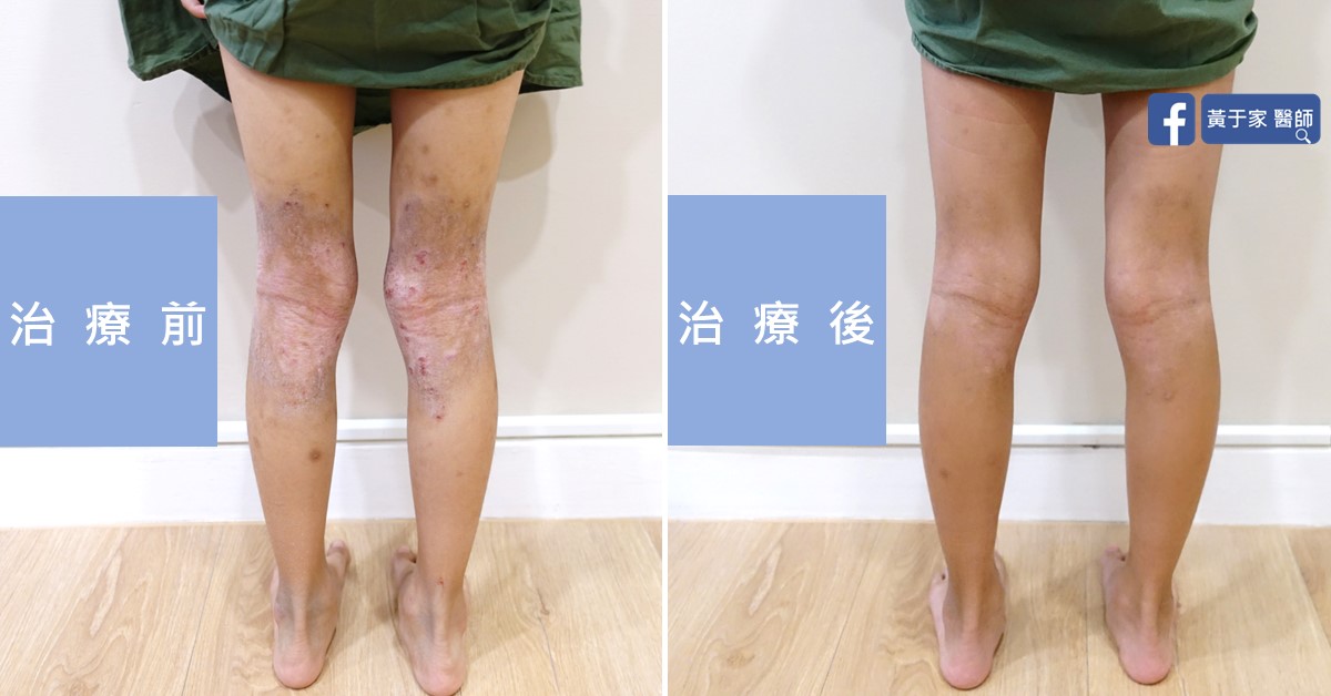 Childhood atopic dermatitis, skin before and after treatment