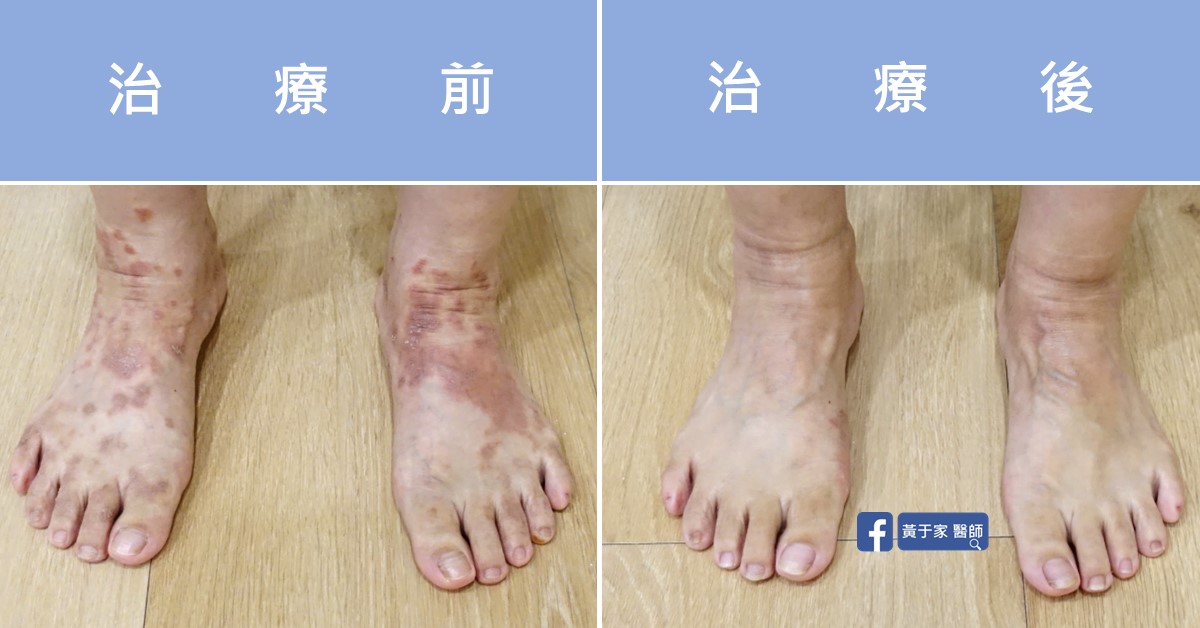 慢性蕁麻疹患者治療前後皮膚外觀比對