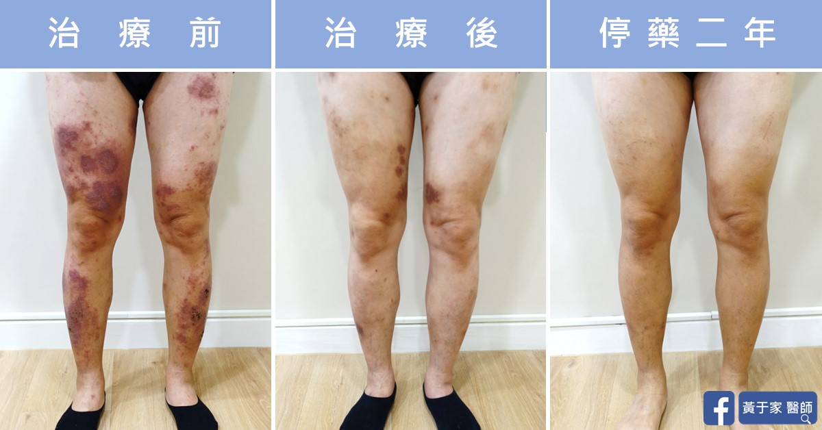 同一位患者雙腿的三張並排照片，依序標示「治療前」「治療後」「停藥二年」